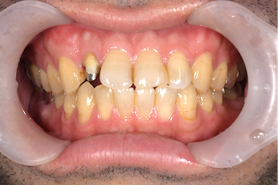 せたがや歯科室｜ブログ｜症例｜【症例】ジルコニアセラミックによる前歯の治療｜治療前の歯の画像