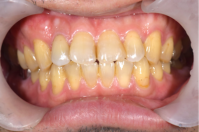 せたがや歯科室｜ブログ｜症例｜【症例】ジルコニアセラミックによる前歯の治療｜治療後の歯の画像