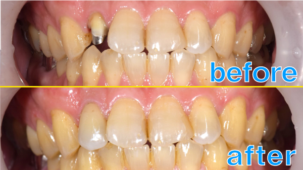 せたがや歯科室｜ブログ｜症例｜【症例】ジルコニアセラミックによる前歯の治療｜治療前後の歯の比較画像