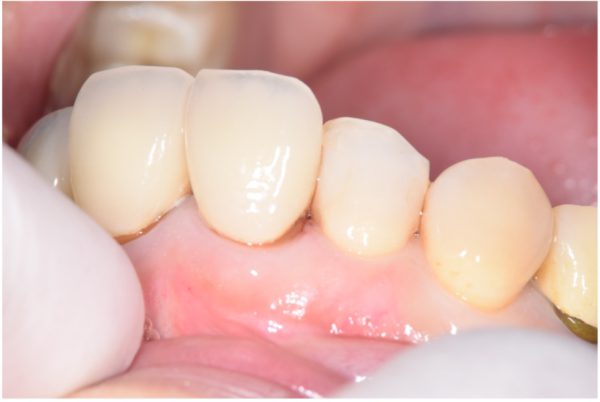 【症例】コンポジットレジンで修復した前歯の二次う蝕の治療