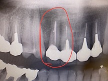 【症例】破折した前歯に対するインプラント治療