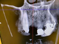 せたがや歯科室｜ブログ｜症例｜【症例】破折した前歯に対するインプラント治療｜骨造成の画像1