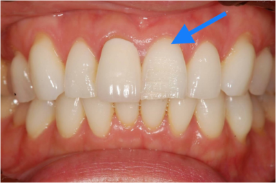 せたがや歯科室｜ブログ｜症例｜【症例】前歯の凹みを削らずにコンポジットレジンで修復｜治療前画像1