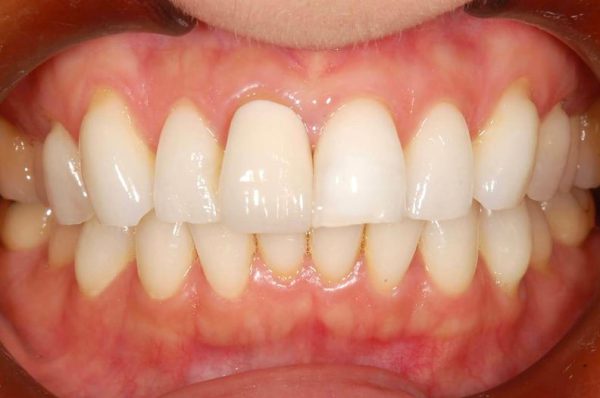 【症例】前歯の凹みを削らずにコンポジットレジンで修復