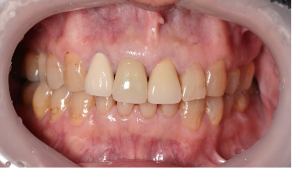 【症例】変色した前歯に対するジルコニアセラミック治療