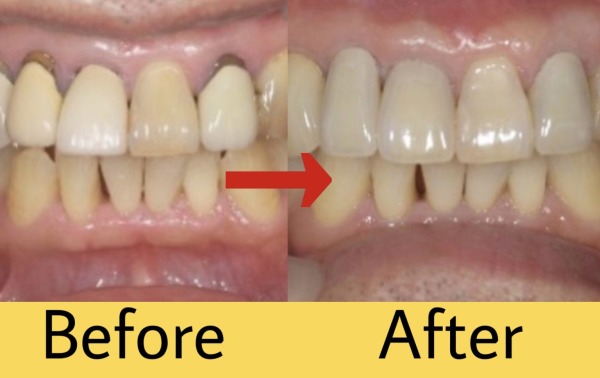 【症例】古い前歯の被せ物をジルコニアセラミックで修復