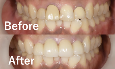 【症例】ホワイトニングと前歯４本のジルコニアセラミックによる審美治療