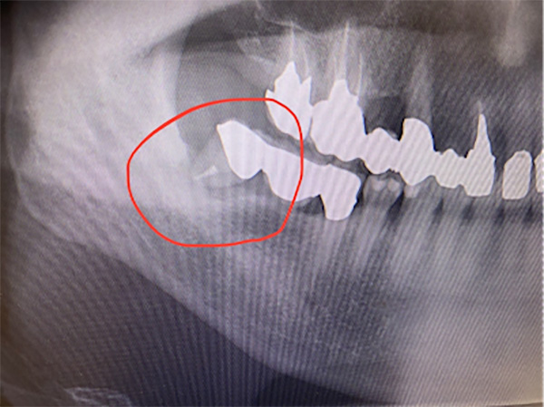 せたがや歯科室｜【症例】ブリッジの土台となっていた大臼歯へのインプラント治療｜治療前の歯のレントゲン画像