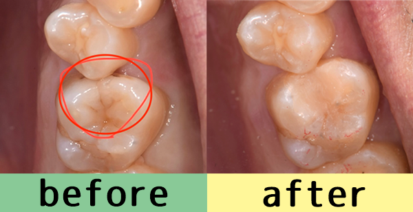 せたがや歯科室｜【症例】肉眼では分かりにくいがレントゲンで見つかった虫歯の治療｜治療前後の比較画像