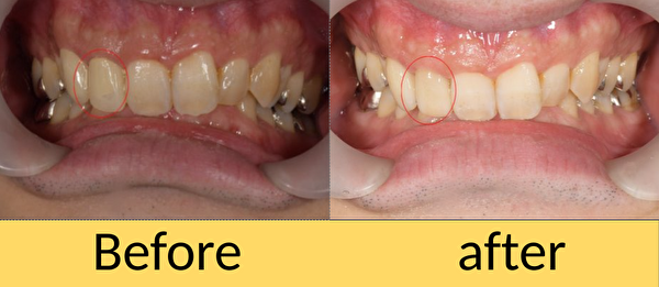 せたがや歯科室｜歯科衛生士ブログ｜【症例】前歯の仮歯をセラミックへ｜アイキャッチ画像