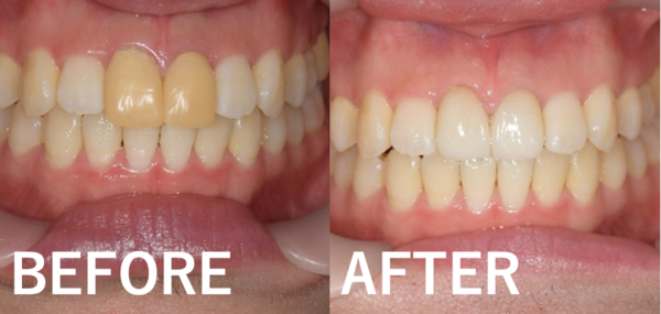 せたがや歯科室｜歯科衛生士ブログ｜【症例】変色した仮歯をセラミックで修復｜アイキャッチ画像