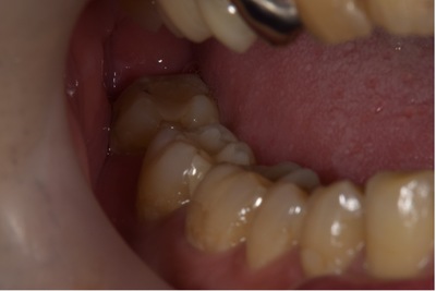 せたがや歯科室｜歯科衛生士ブログ｜【症例】銀歯を白いジルコニアに変えて目立たない見た目に｜治療後画像