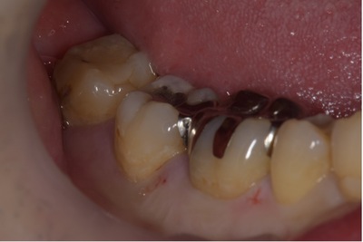 せたがや歯科室｜歯科衛生士ブログ｜【症例】銀歯を白いジルコニアに変えて目立たない見た目に｜治療前画像