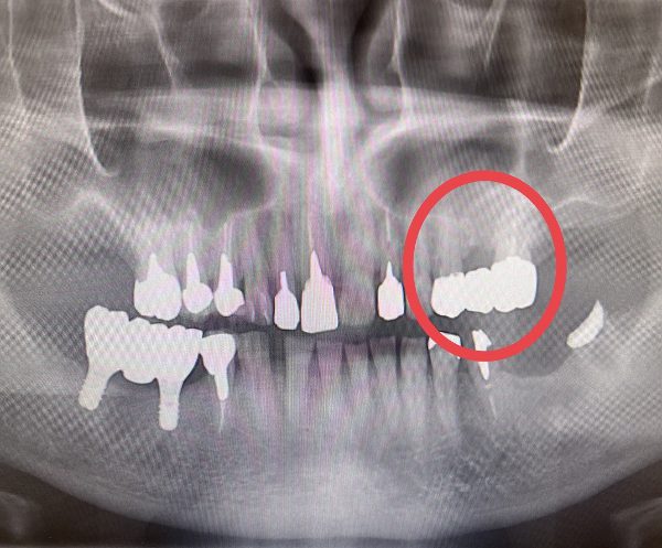 【症例】虫歯になってしまった神経のない奥歯に対する再根管治療