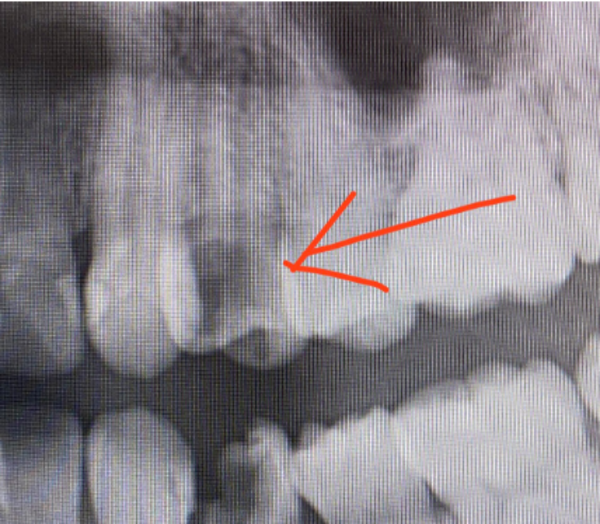 【症例】歯質が大きく失われた歯を保存する部分矯正