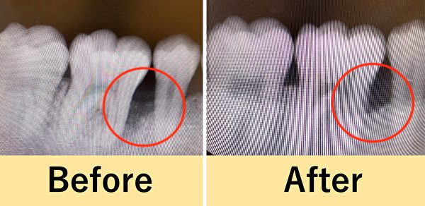 【症例】歯の周りの溶けた骨を歯周再生療法で治療