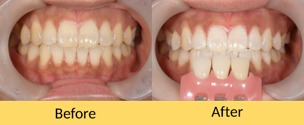 せたがや歯科室｜歯科医師ブログ｜【症例】ホワイトニングでさらに自然で綺麗な白い歯に｜アイキャッチ画像