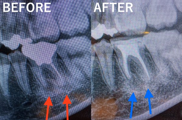 【症例】膿が溜まってしまった神経のない歯に対する再根管治療