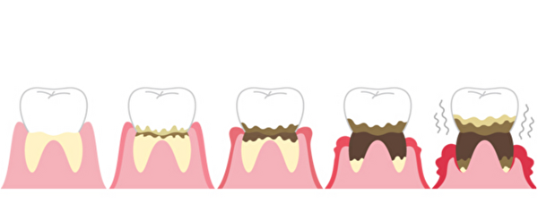せたがや歯科室｜ブログ｜骨が破壊される病気「歯周病」について解説｜アイキャッチ画像