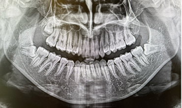 せたがや歯科室｜ブログ｜骨が破壊される病気「歯周病」について解説｜レントゲン撮影