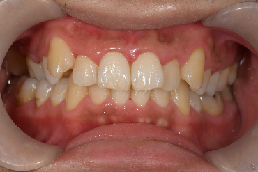 せたがや歯科室｜ブログ｜歯周病治療とセルフケアの重要性｜歯周病治療後
