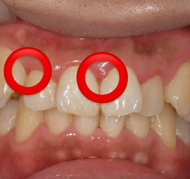 せたがや歯科室｜ブログ｜歯周病治療とセルフケアの重要性｜歯茎の腫れ