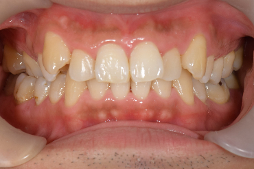 せたがや歯科室｜ブログ｜歯周病治療とセルフケアの重要性｜歯ブラシ指導後