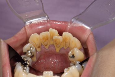 せたがや歯科室｜ブログ｜歯周病治療とセルフケアの重要性｜前歯の裏側の歯石