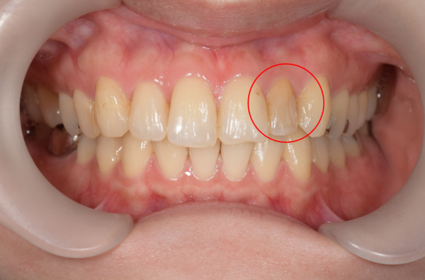 せたがや歯科室｜症例｜変色の気になる前歯をセラミック治療で自然な見た目に｜治療前