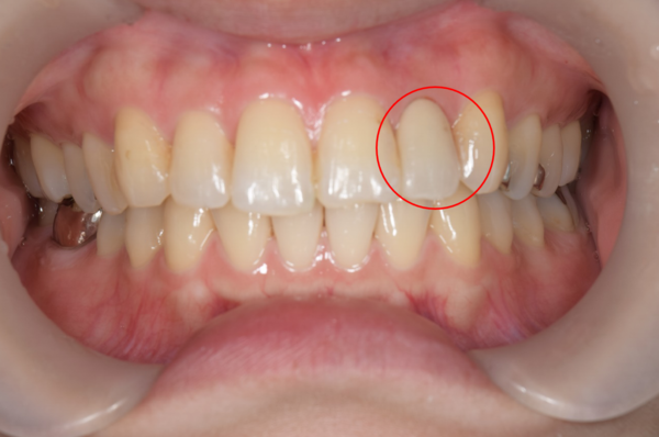 せたがや歯科室｜症例｜変色の気になる前歯をセラミック治療で自然な見た目に｜治療後