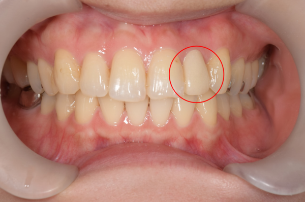 せたがや歯科室｜症例｜変色の気になる前歯をセラミック治療で自然な見た目に｜治療詳細