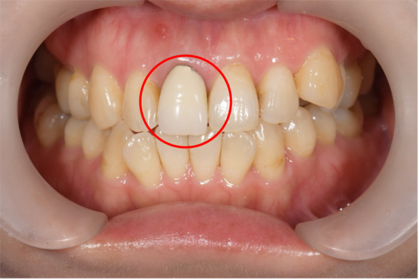 せたがや歯科室｜症例｜保険適用の被せ物を綺麗なセラミックへ｜治療前