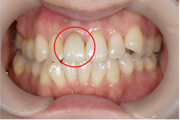 せたがや歯科室｜症例｜保険適用の被せ物を綺麗なセラミックへ｜治療後