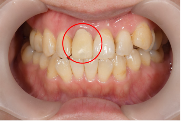 せたがや歯科室｜症例｜保険適用の被せ物を綺麗なセラミックへ｜古いセラミックを外した