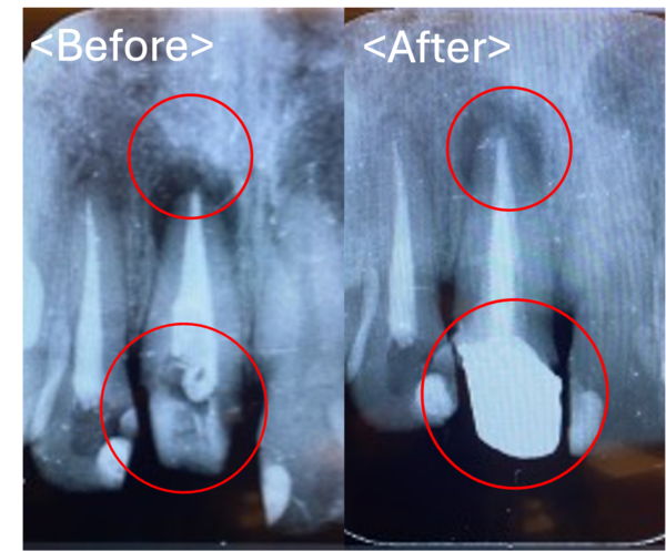 【症例】古い被せ物の交換と膿が溜まった神経の再治療