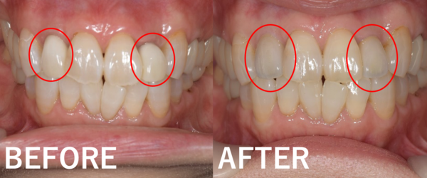 【症例】色や形が気になる前歯に対するジルコニアセラミックを用いた審美的治療