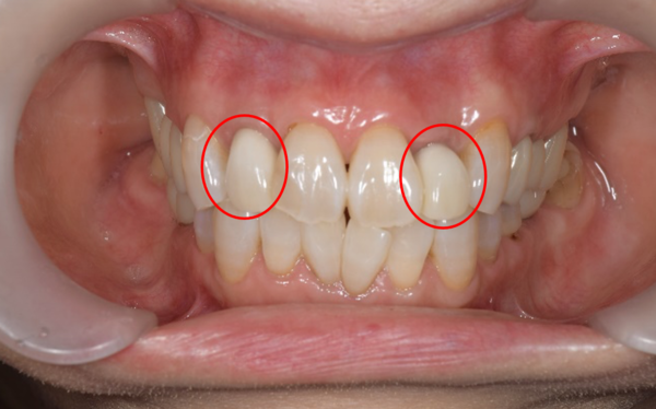 せたがや歯科室｜症例｜色や形が気になる前歯に対するジルコニアセラミックを用いた審美的治療｜治療前