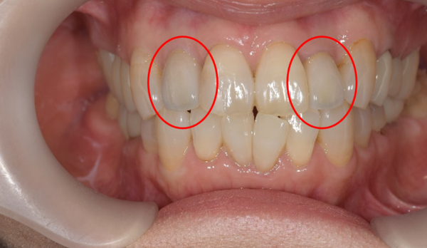 せたがや歯科室｜症例｜色や形が気になる前歯に対するジルコニアセラミックを用いた審美的治療｜治療後