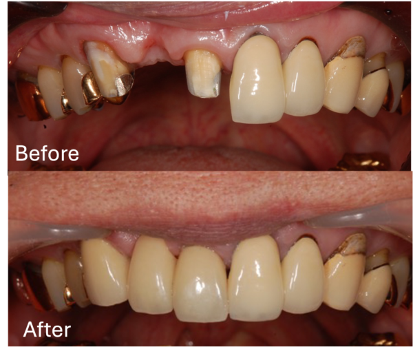 せたがや歯科室｜症例｜抜歯後に隣の被せ物と合わせてブリッジを作成｜アイキャッチ
