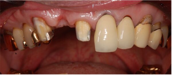 せたがや歯科室｜症例｜抜歯後に隣の被せ物と合わせてブリッジを作成｜入れ歯差し込み前