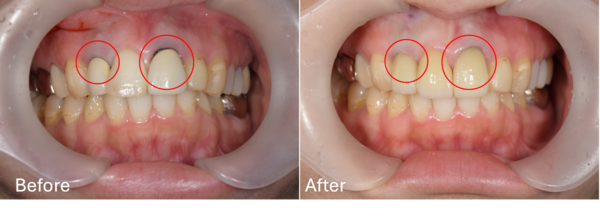 せたがや歯科室｜症例｜気になる前歯を綺麗なセラミックへ｜eyechatch
