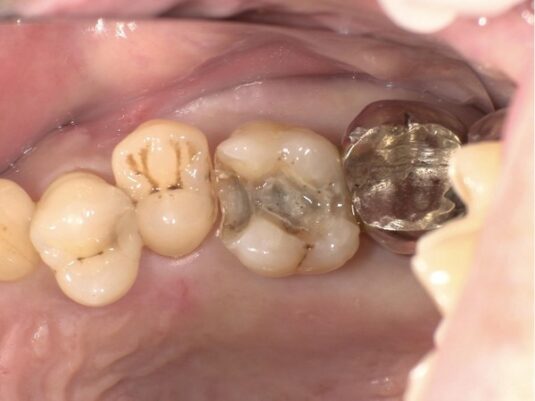 銀歯を外した写真｜【症例】e-maxを用いた劣化した銀歯のやり変え｜せたがや歯科室