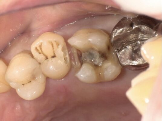 レジンを詰めた写真１｜【症例】e-maxを用いた劣化した銀歯のやり変え｜せたがや歯科室