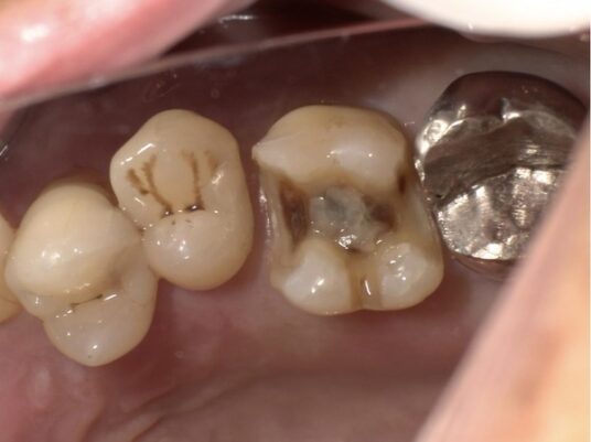 レジンを詰めた写真２｜【症例】e-maxを用いた劣化した銀歯のやり変え｜せたがや歯科室