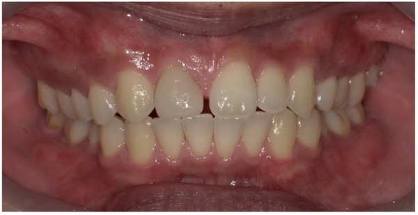 治療前口腔内写真｜【症例】すきっ歯のセラミックによる修復を希望｜松陰神社の歯医者せたがや歯科室
