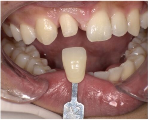 セラミック挿入前色合わせ｜【症例】すきっ歯のセラミックによる修復を希望｜松陰神社の歯医者せたがや歯科室