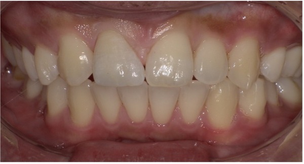 治療後口腔内写真｜【症例】すきっ歯のセラミックによる修復を希望｜松陰神社の歯医者せたがや歯科室