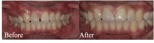 Before-After画像|【症例】すきっ歯をジルコニアセラミックにより修復|松陰神社の歯医者せたがや歯科室