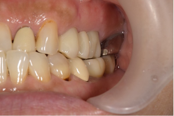 治療後口腔内画像|【症例】奥歯のブリッジをジルコニアへ|松陰神社の歯医者せたがや歯科室