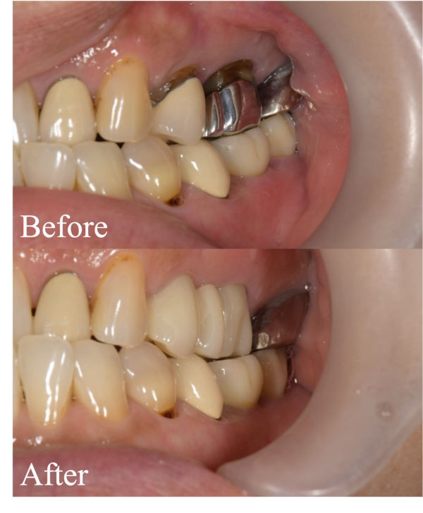 Before-After画像｜【症例】奥歯のブリッジをジルコニアへ｜松陰神社の歯医者せたがや歯科室
